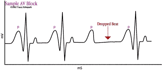 Sample EKG with AV Block